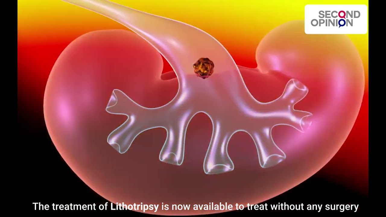 Kidney stone problems | Second Opinion | Online Doctor Consultation