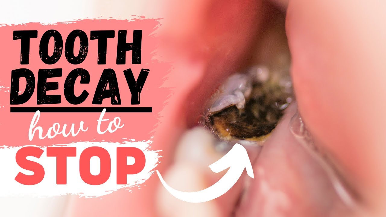 Tooth Decay (Treatment for a Tooth Cavity)