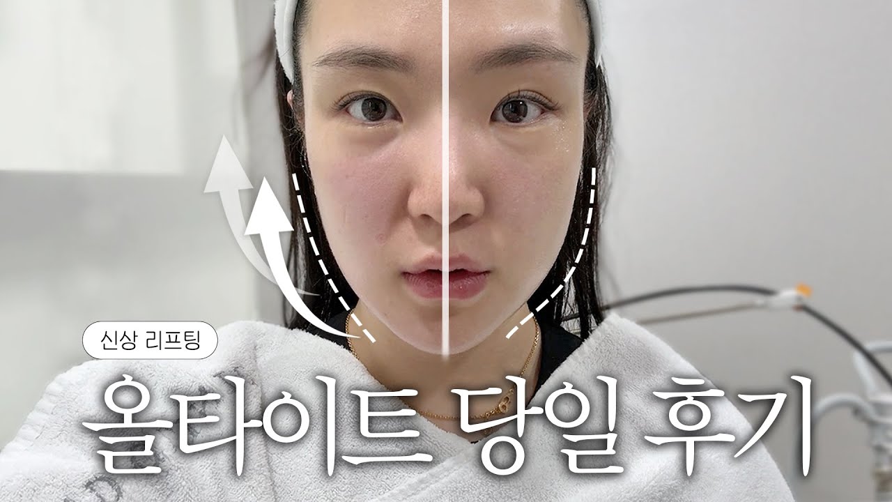 울써마지 대체? 신상 올타이트 리프팅의 모든 것✨ (효과, 통증, 유지기간, 추천or비추천 등등)