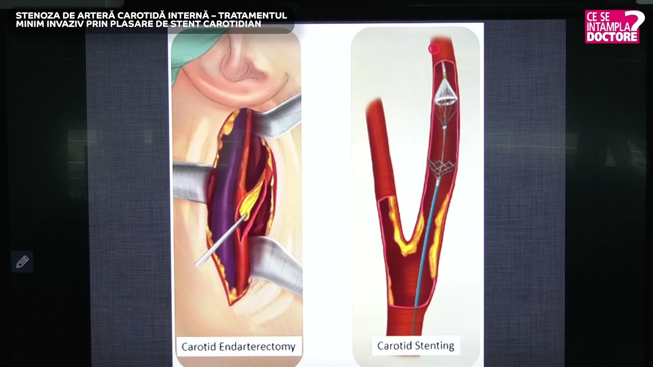 Stenoza de arteră carotidă internă – tratamentul minim invaziv prin plasare de stent carotidian