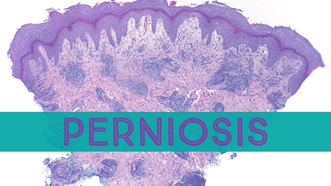 Perniosis/Chilblains (one cause of blue/purple fingers and toes in cold weather)