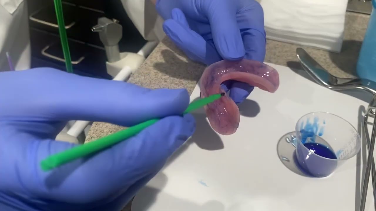 Applying PVS Adhesive for a Denture Wash/Reline Impression