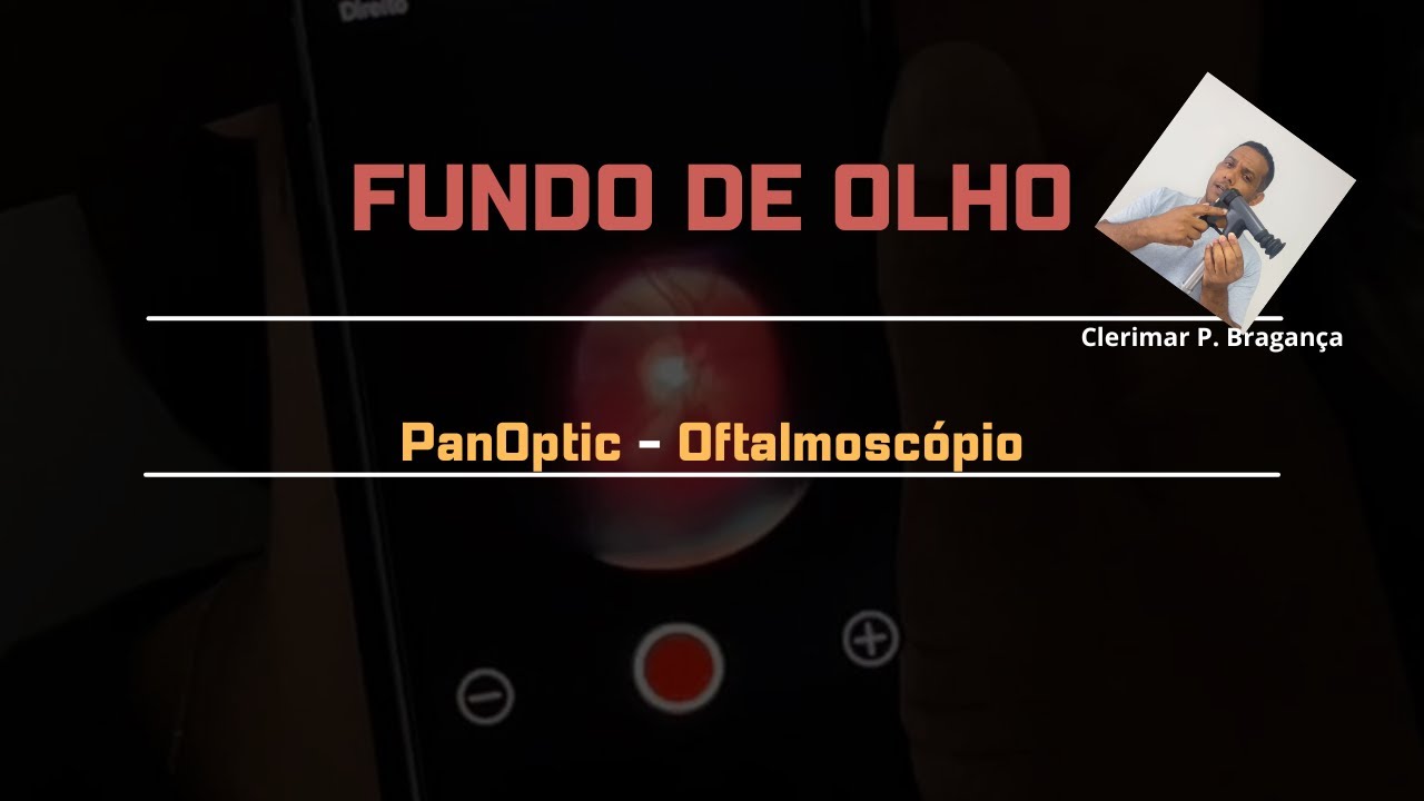 Fundo de Olho com o oftalmoscópio PanOptic Welch Allyn