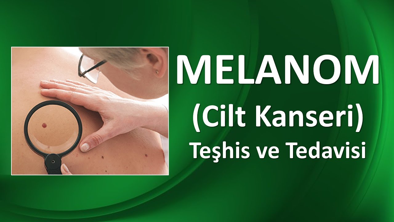 MELANOM NEDİR? Teşhis ve Tedavisi Nasıl Gerçekleşir?