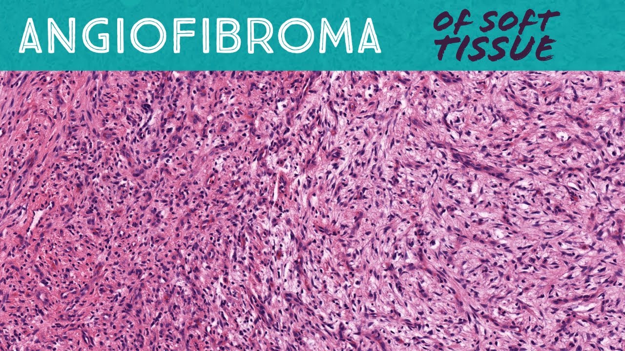 Angiofibroma of soft tissue (AIP France 2021 - Case 14)
