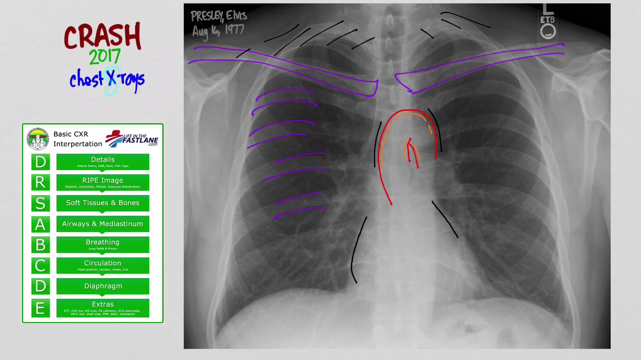 02 CXR: DRS ABCDE Method