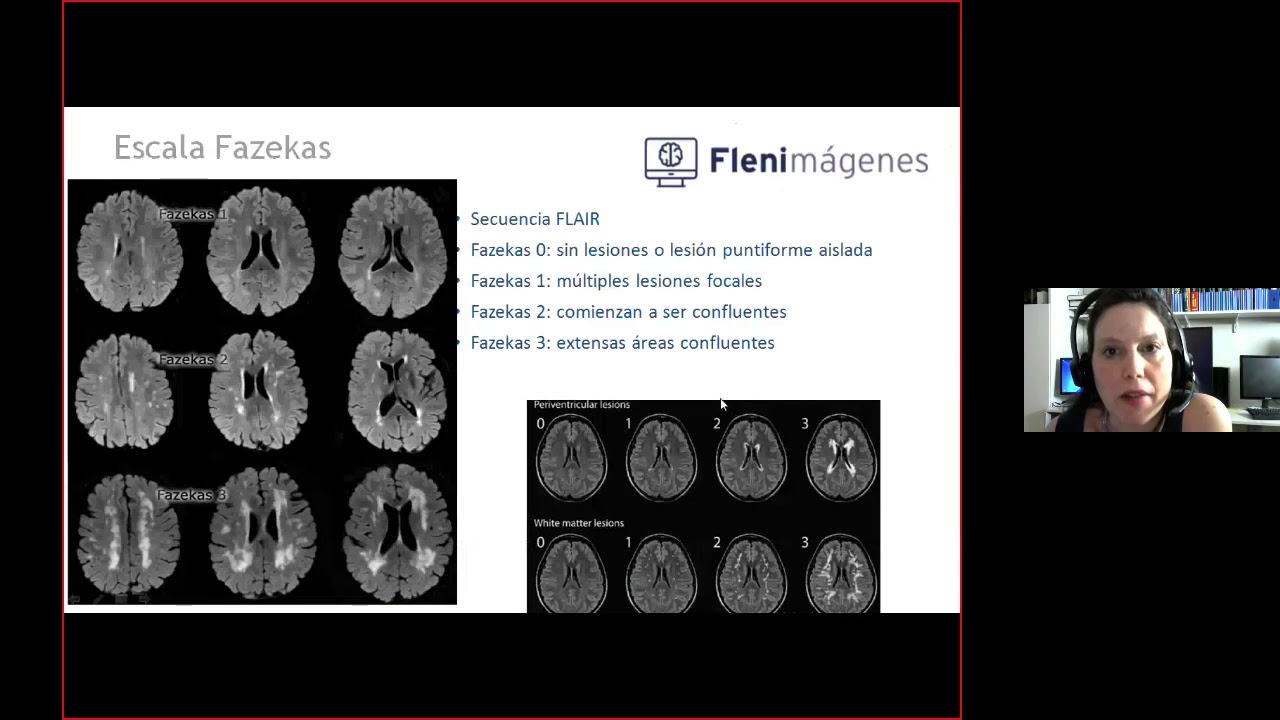 Webinar Imágenes en Neurocognitivo: Evaluación por Imágenes del Deterioro Cognitivo