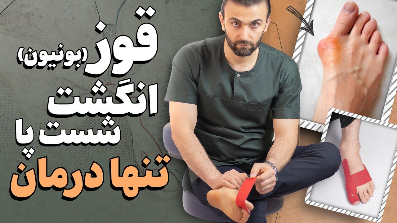 بهترین درمان هالوکس والگوس (قوز انگشت شست پا) در خانه | فقط با چسب درمانی بونیون پا رو درمان کن
