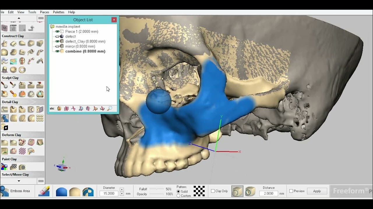 Maxilla Implant Modelling usuing Geomagic Freeform
