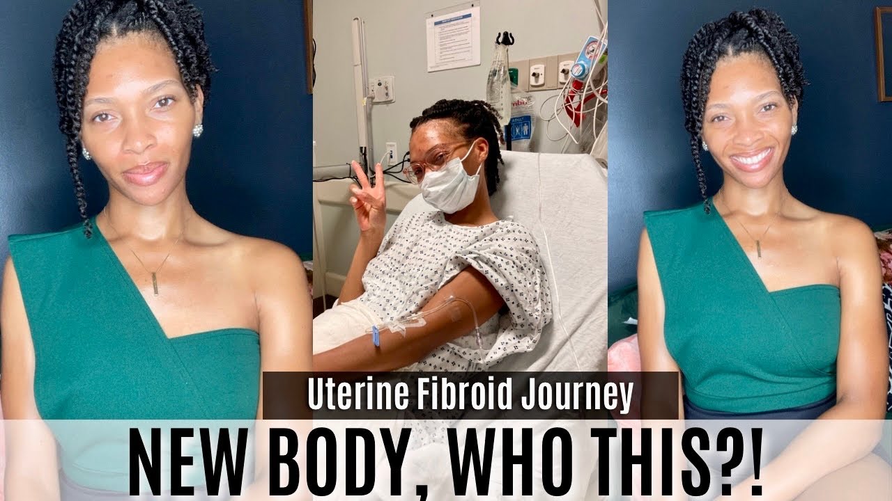 It's Giving BBL| My Fibroid & Myomectomy Surgery Journey| Surgery Prep & Recovery, Part 2/3