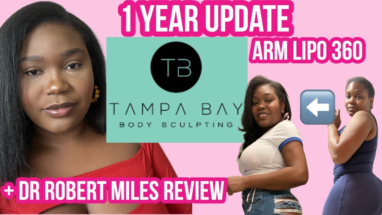 1 Year Post Op Arm Lipo 360 | Dr Miles Tampa Bay Body Sculpting Review | Autograph Arms