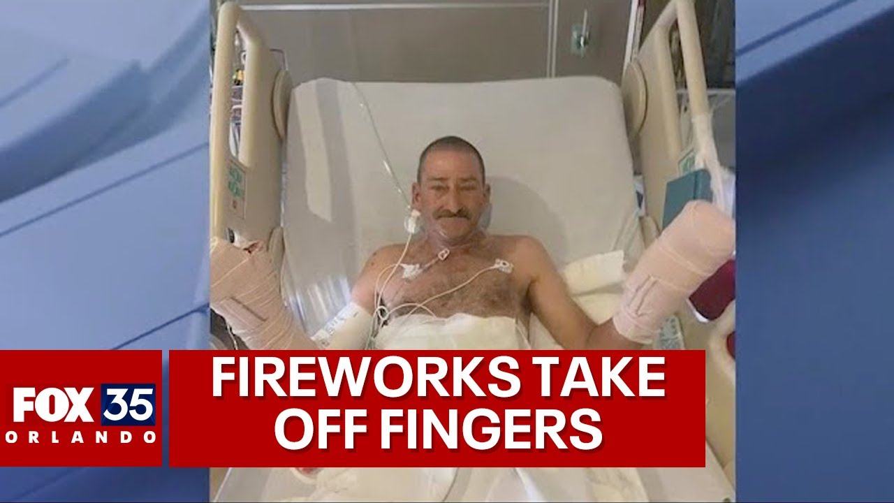 Florida man loses most of his fingers in fireworks explosion