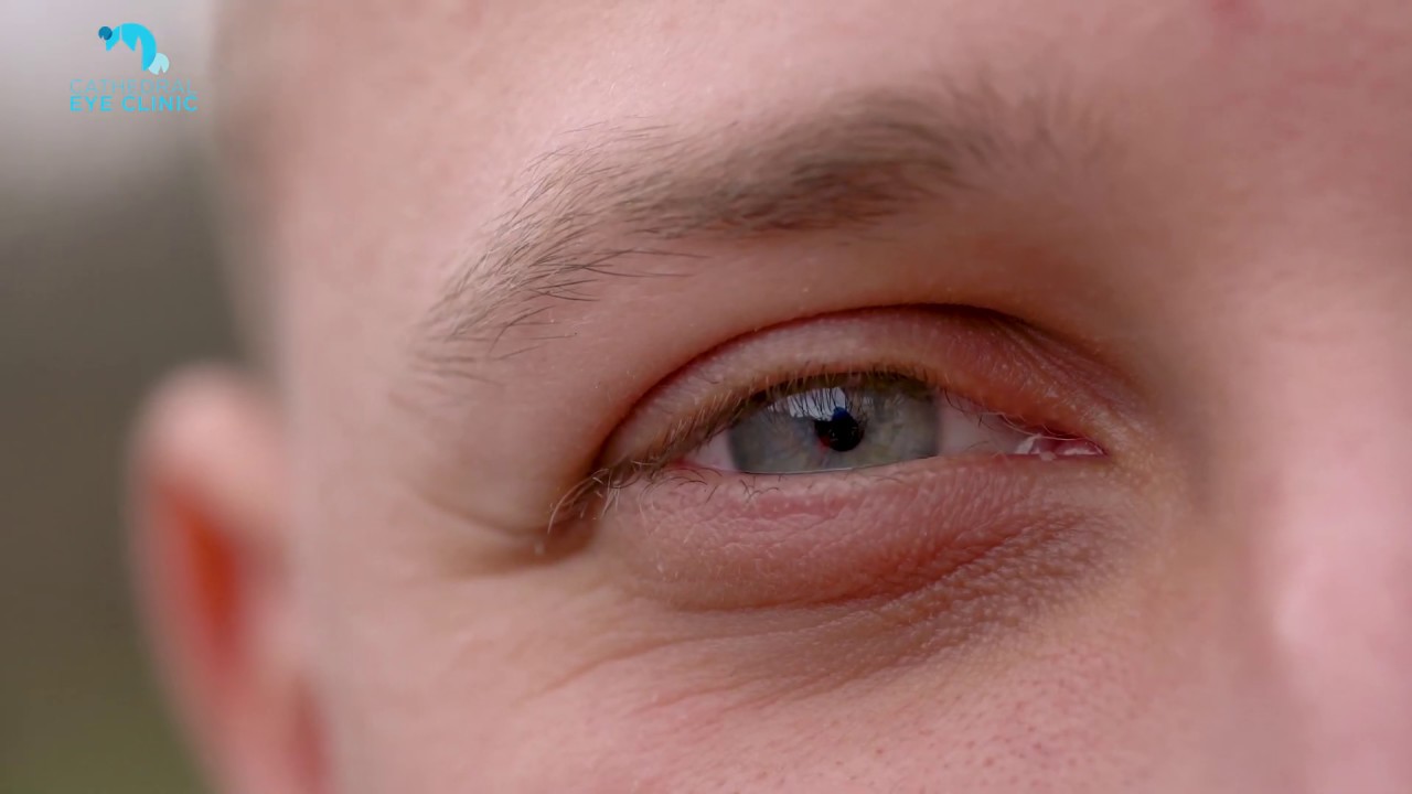 Laser Eye Surgery Age | Laser Eye Surgery Age Limit | Laser Eye Surgery For Over 50s