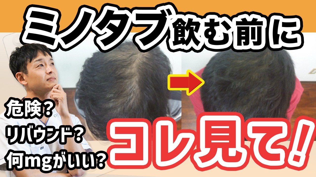 ミノキシジルタブレットを飲む前に見てほしい。濃度・タイミング・購入場所の考え方【2.5mg、5mg、10mg？】
