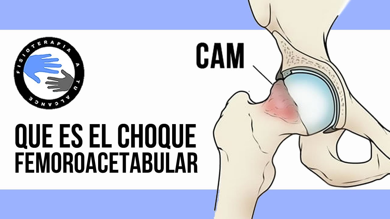 Choque femoroacetabular, que es, por que se produce, cuales son sus sintomas