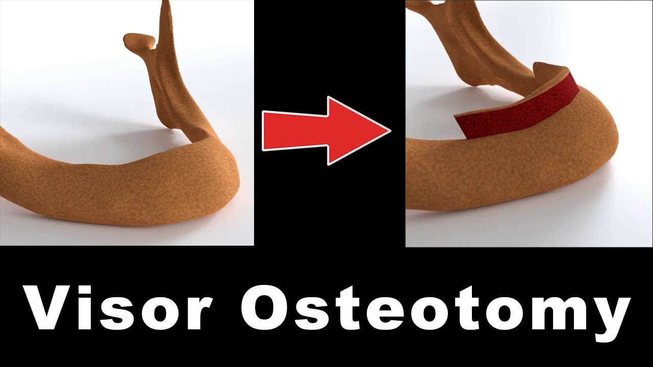 Visor & Modified Visor Osteotomy