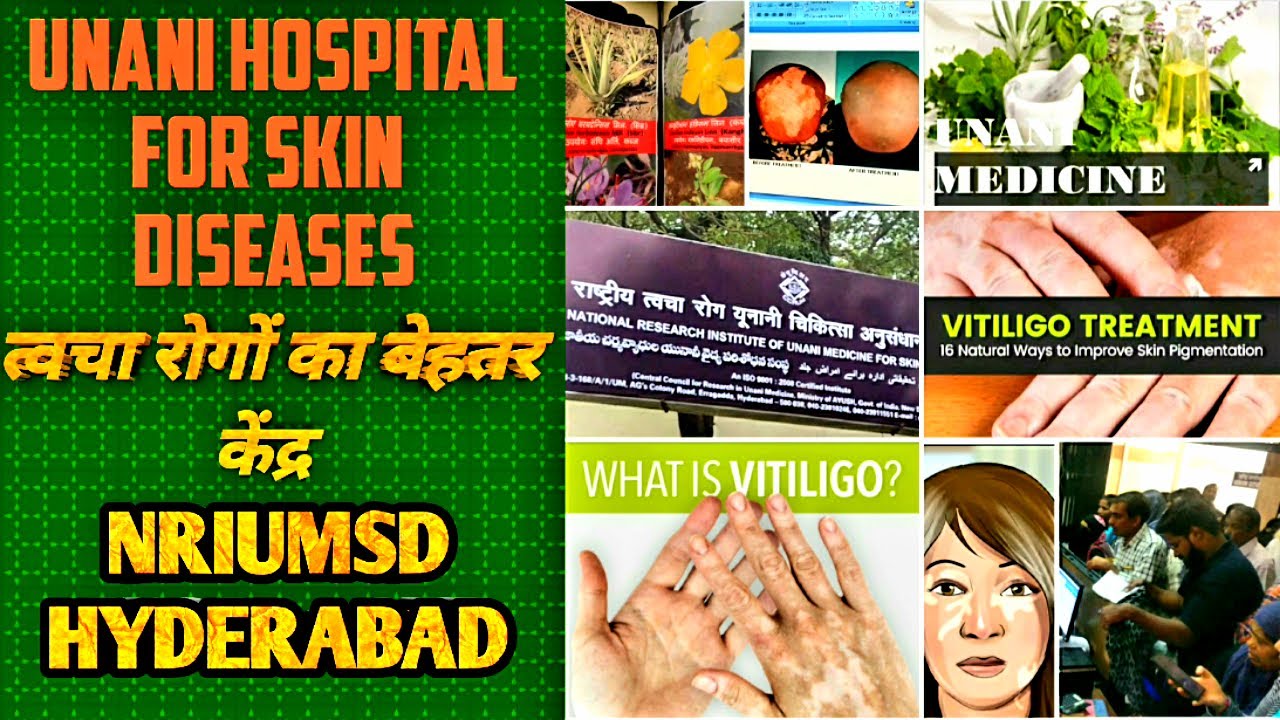 Unani Hospital For Skin Diseases NRIUMSD | Vitiligo Treatment | Vitiligo Cure | Skin Diseases