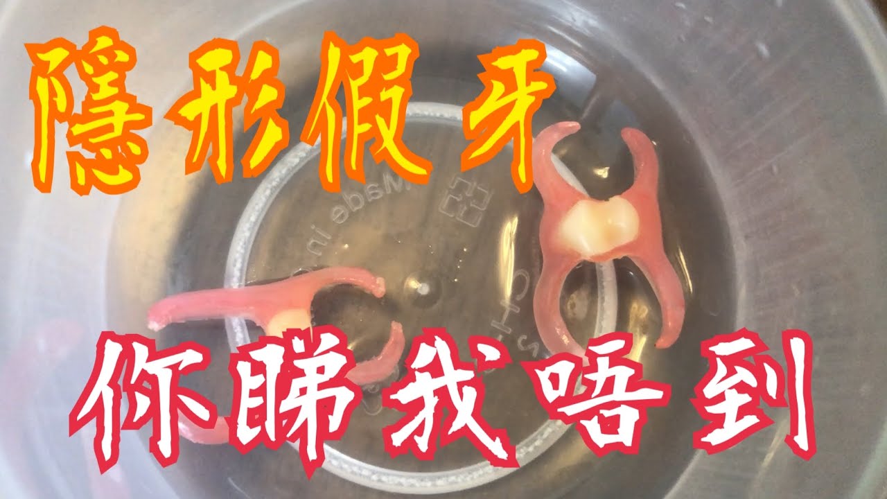 隱形活動假牙💯 你睇我唔到 😂 分享好處 👍🏻壞處🤔Invisible removable dentures 💯 You can't see me 😂 Share experience