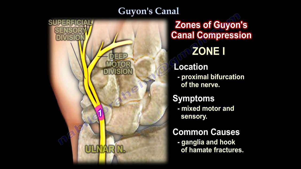 Guyon's Canal , Ulnar tunnel syndrome .Everything You Need To Know - Dr. Nabil Ebraheim