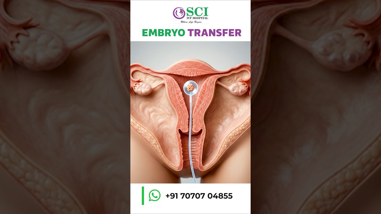 IVF Step Explained: Embryo Transfer Simplified for You 💡 #ivftreatment #ivfsuccesstips