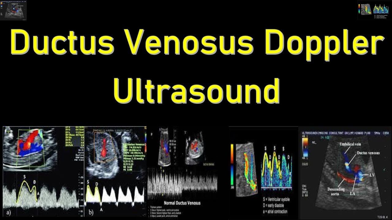 Fetal Ductus Venosus Doppler Ultrasound Interpretation