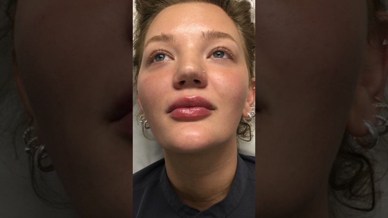 Restylane Kysse Lip Filler Before & After