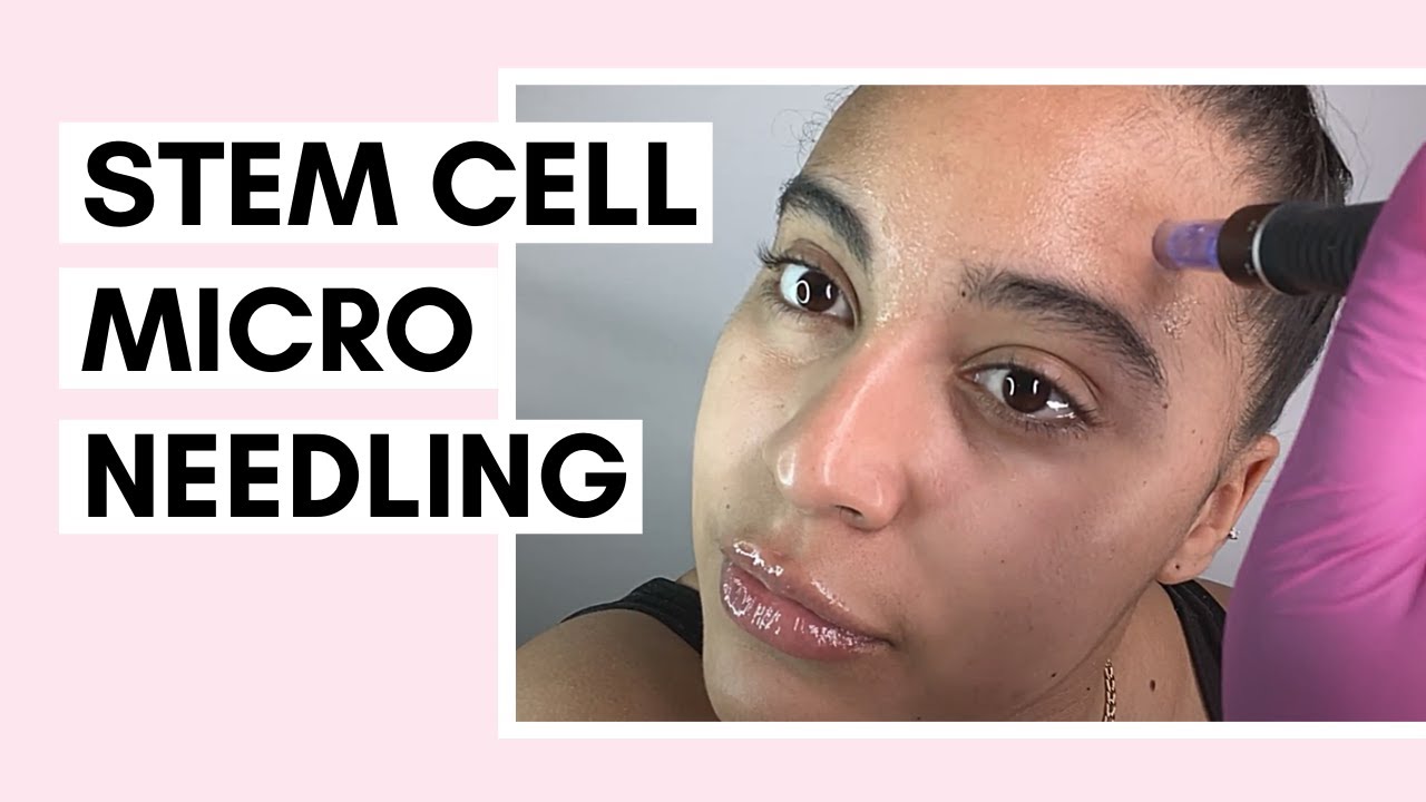 Dr. Drawing Stem Cell Skin Booster Micro Needling with Dr. Pen Ft@SaigeWellington