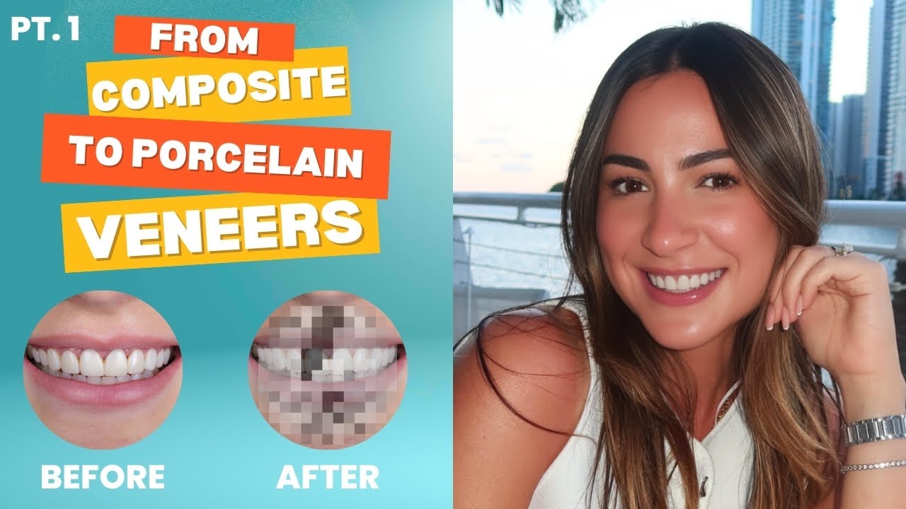 pov: doing the switch from composite to porcelain veneers (smile makeover)