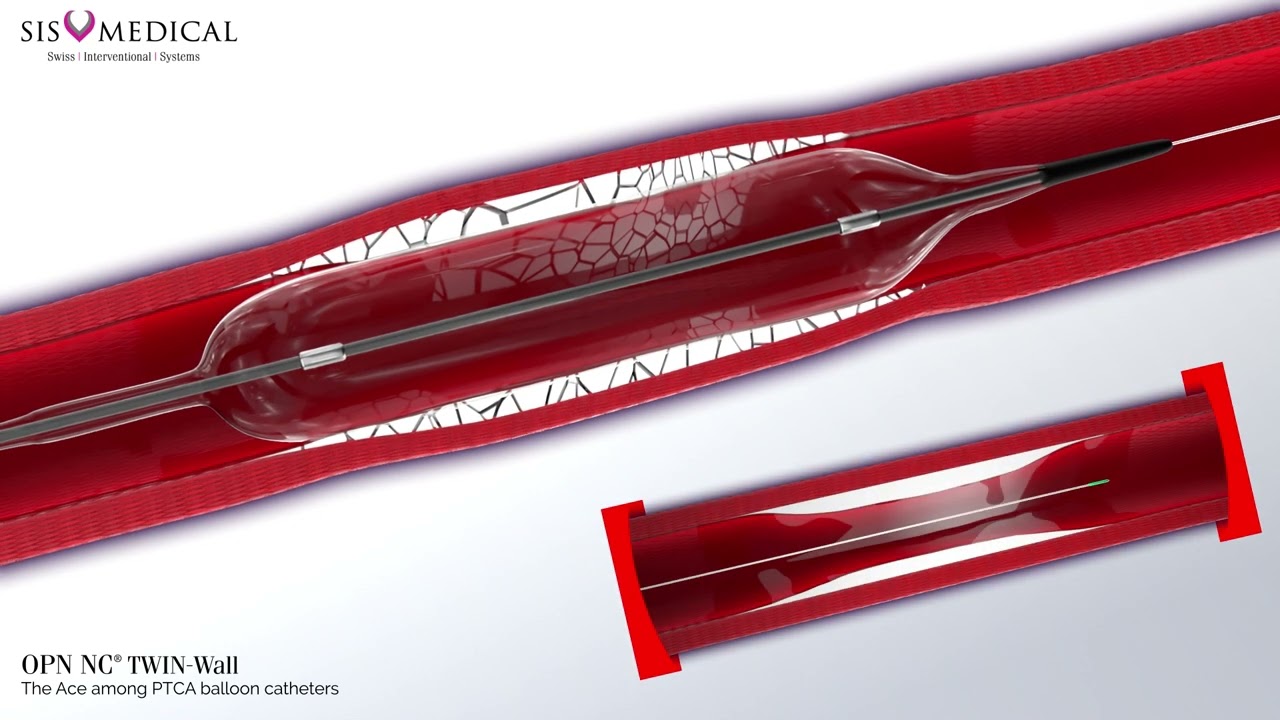 OPN NC TWIN Wall PTCA Balloon Animation