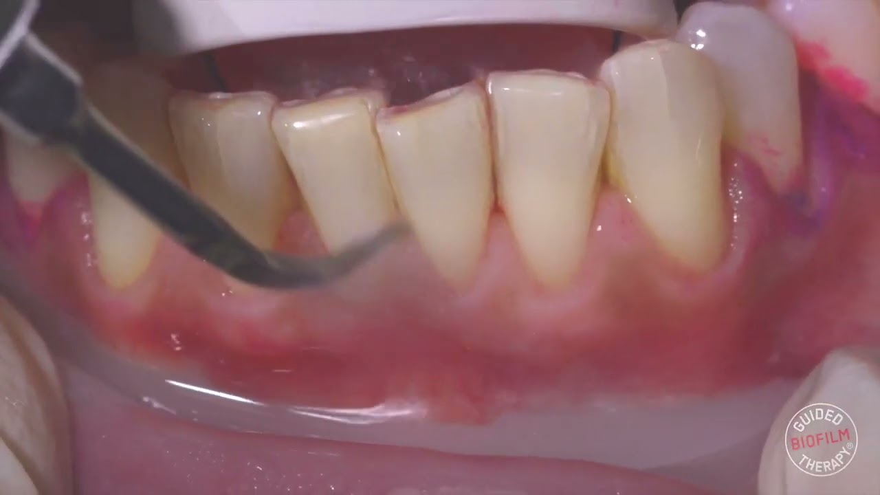 Pulizia Denti con il Protocollo GBT Napoli