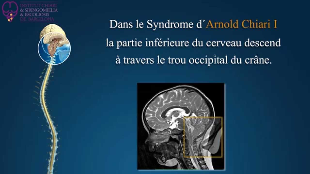 Syndrome de Arnold Chiari, Syringomyélie et Scoliose - Institut Chiari de Barcelona