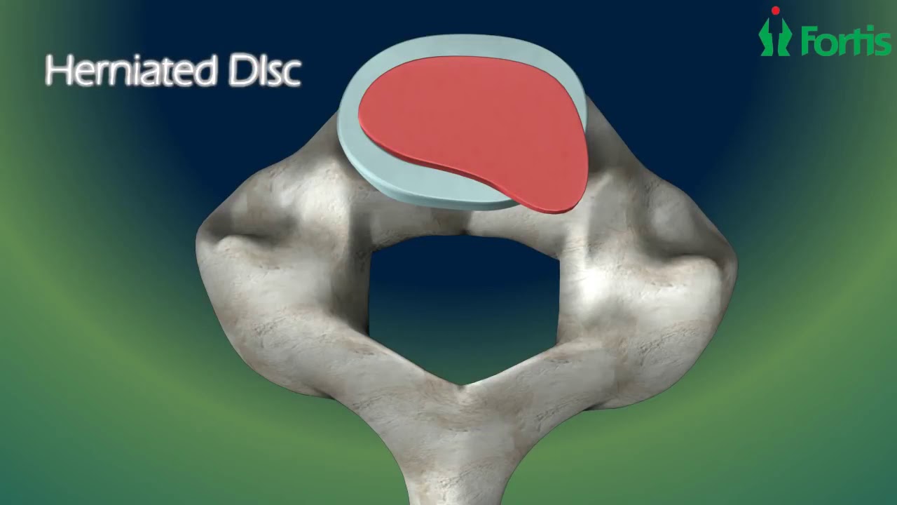 Micro Lumbar Discectomy & Fusion  Spine Surgery Neuro Surgery; Fortis Healthcare,India 1