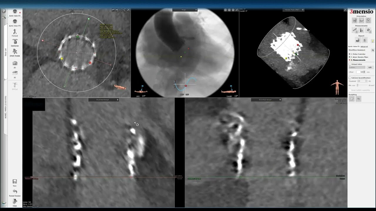 3Mensio CT Pre-case Planning: Redo-TAVR with Prior Sapien 3 (1 of 2)