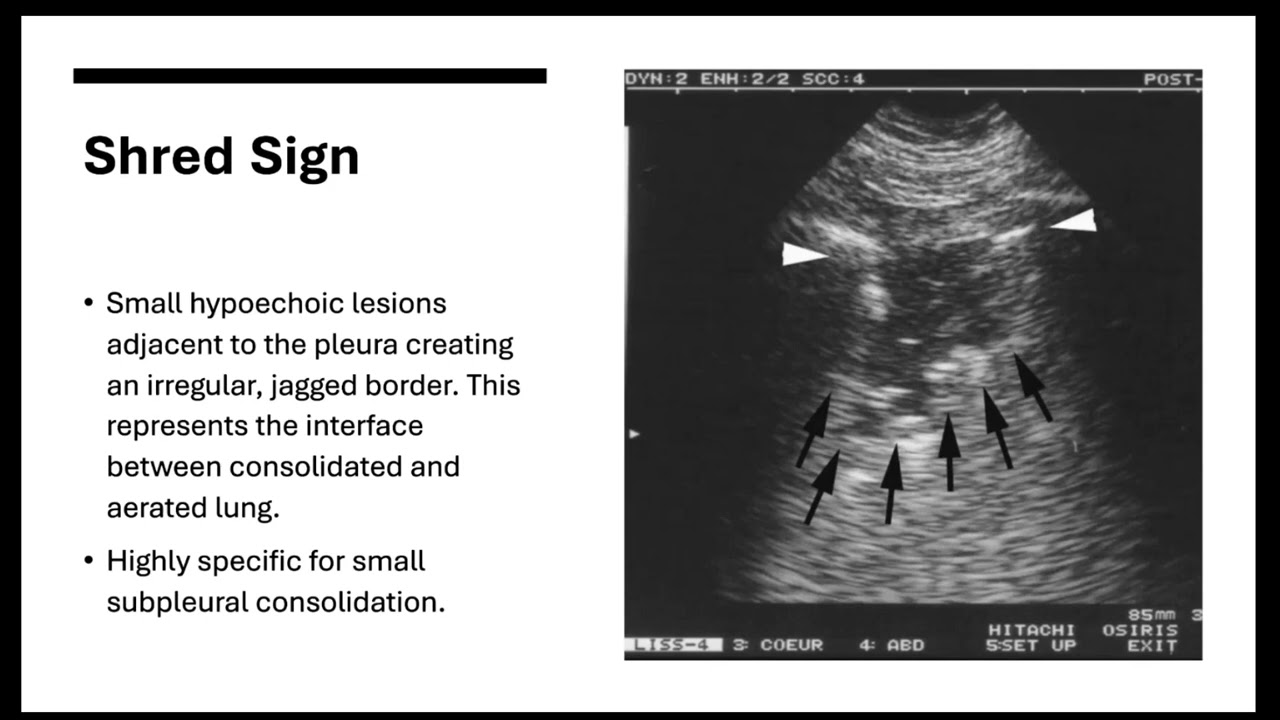 POCUS for Detecting Pneumonia