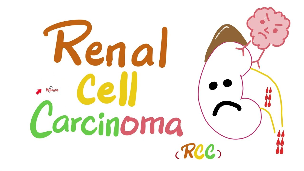 Renal Cell Carcinoma (RCC) - Kidney Tumors - Neoplasms - Renal Pathology - Nephrology