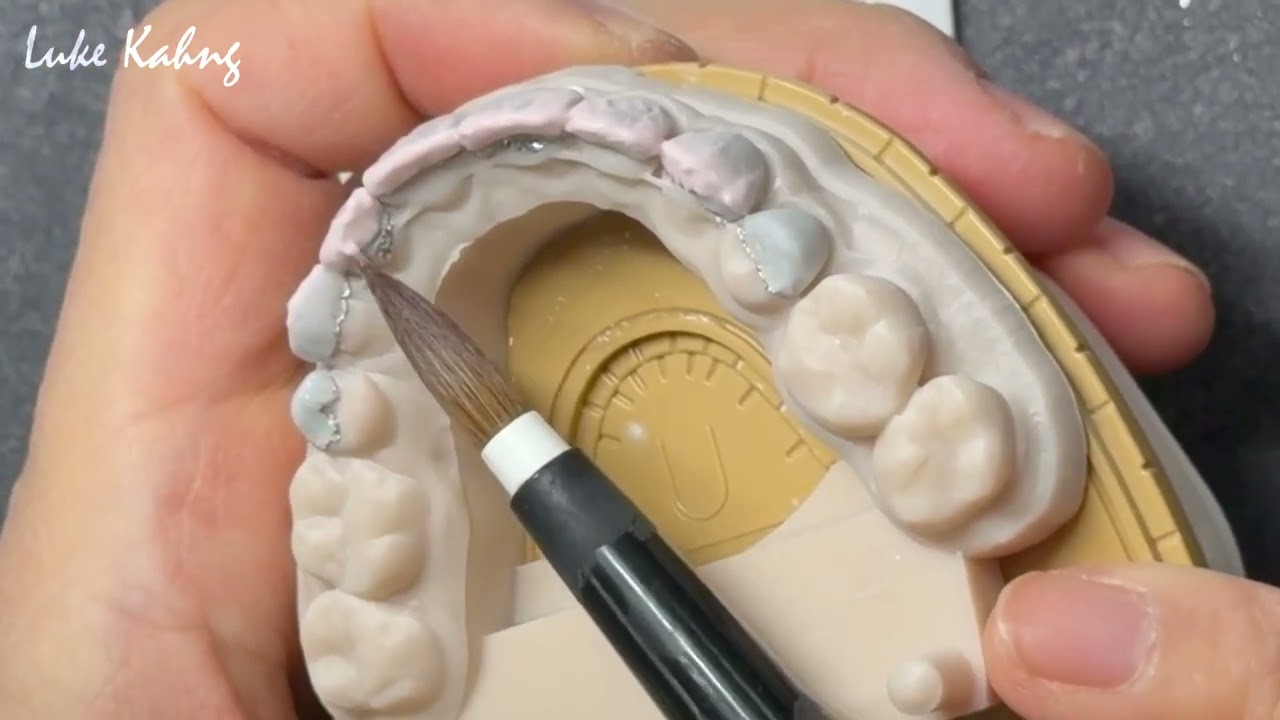 Platinum Foil Technique, Step-By-Step, Part 5