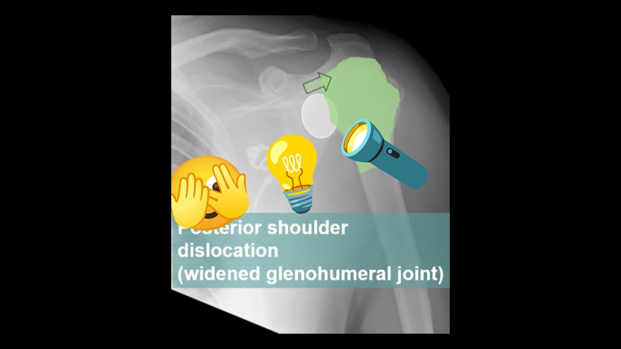 Posterior shoulder dislocation