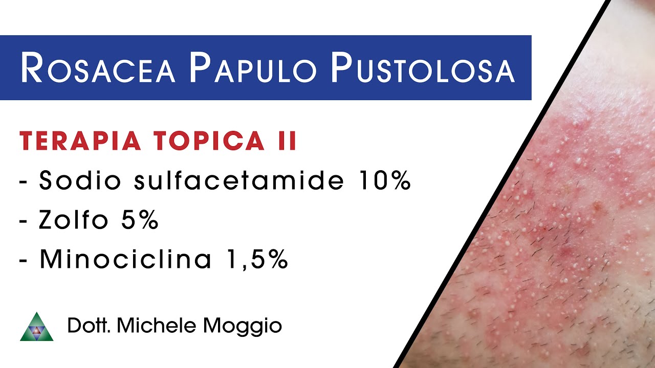 ROSACEA PAPULO PUSTOLOSA - Terapia Topica II  | dott. Michele Moggio