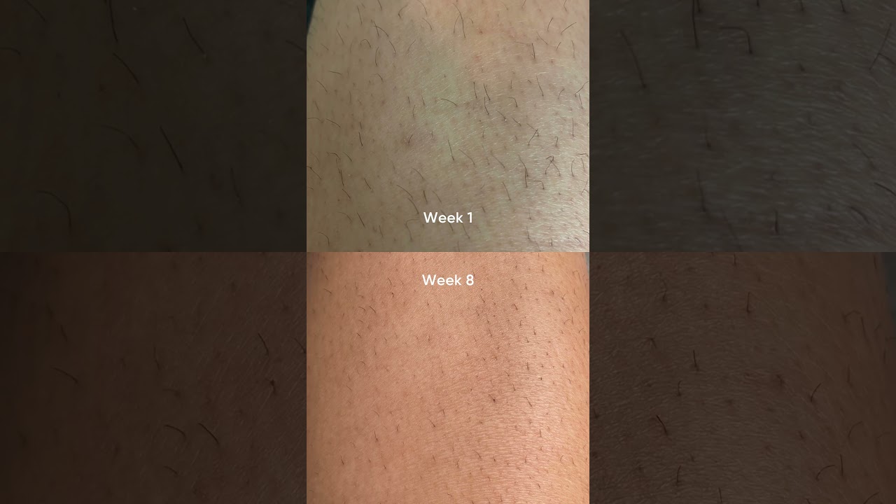 Before and after using Lumi IPL Hair Removal  #beauty #skincare