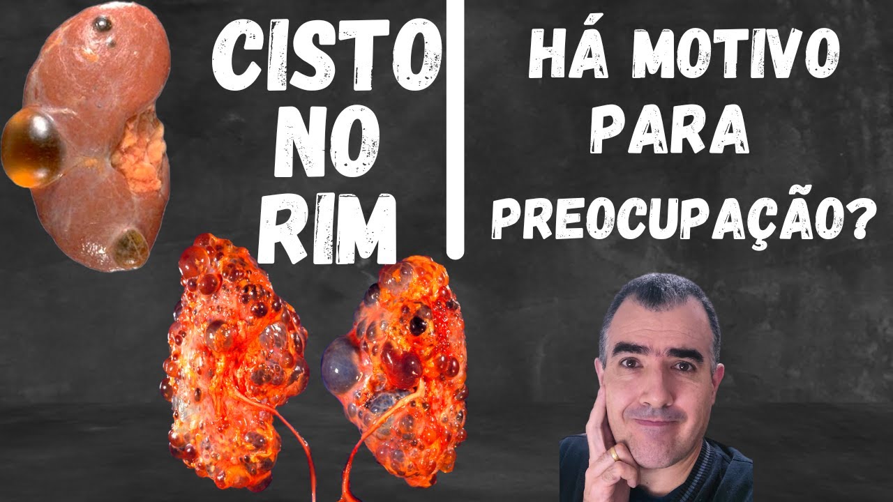 Cisto no rim: Há motivo para preocupação?