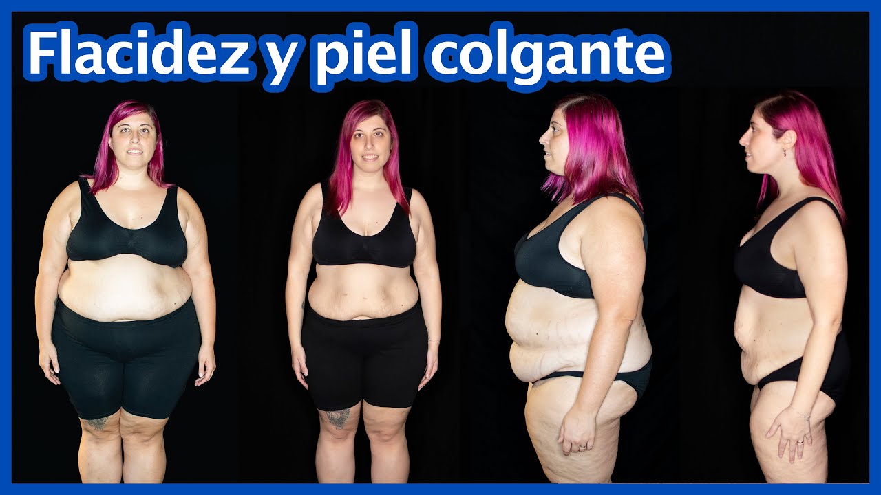 Bypass gástrico -  Flacidez y piel colgante