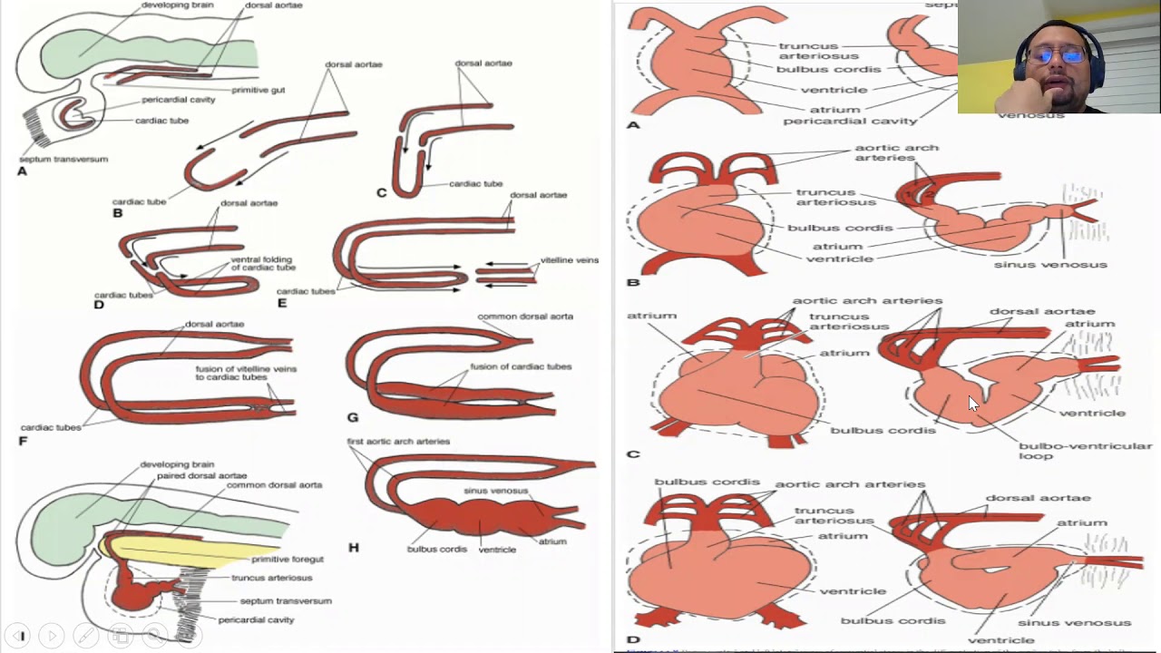 Ventricular Septal Defect
