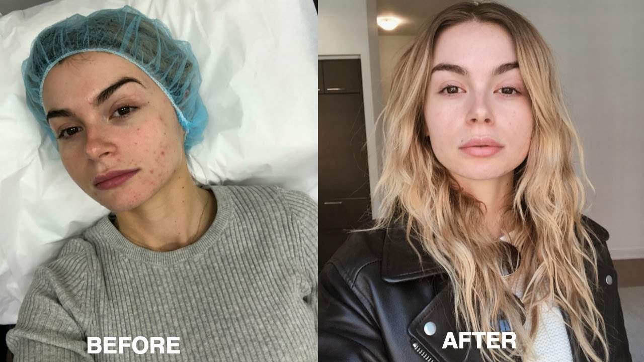 SKINCARE ROUTINE | products + tips for zits and scarring