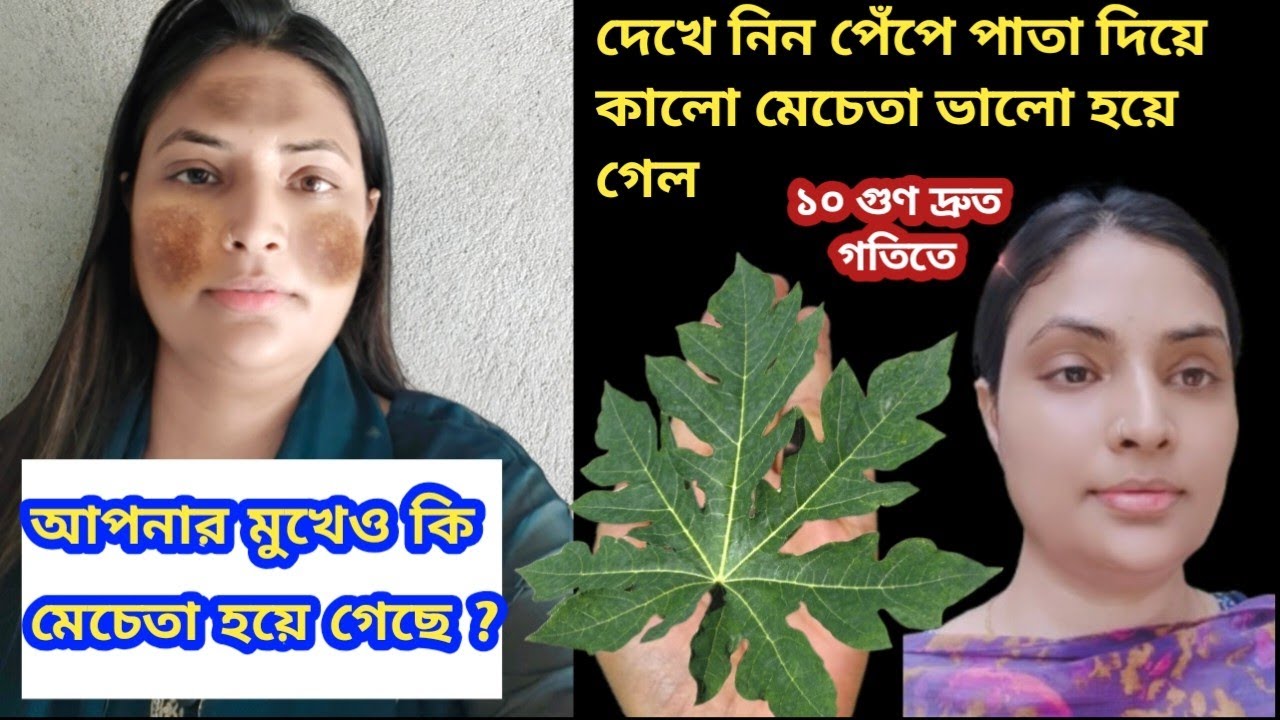 পেঁপে পাতা দিয়ে কঠিন মেছতার দাগ দূর হবে / Reduce Melasma, pigmentation, discoloration, blackspots
