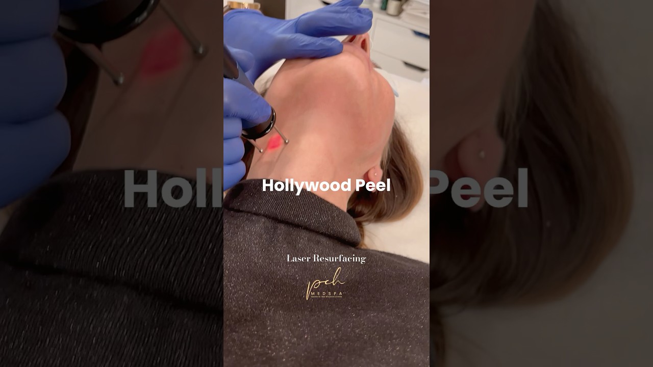 Laser Resurfacing, Hollywood Peel Laser, PCH MedSpa, Orange County, CA