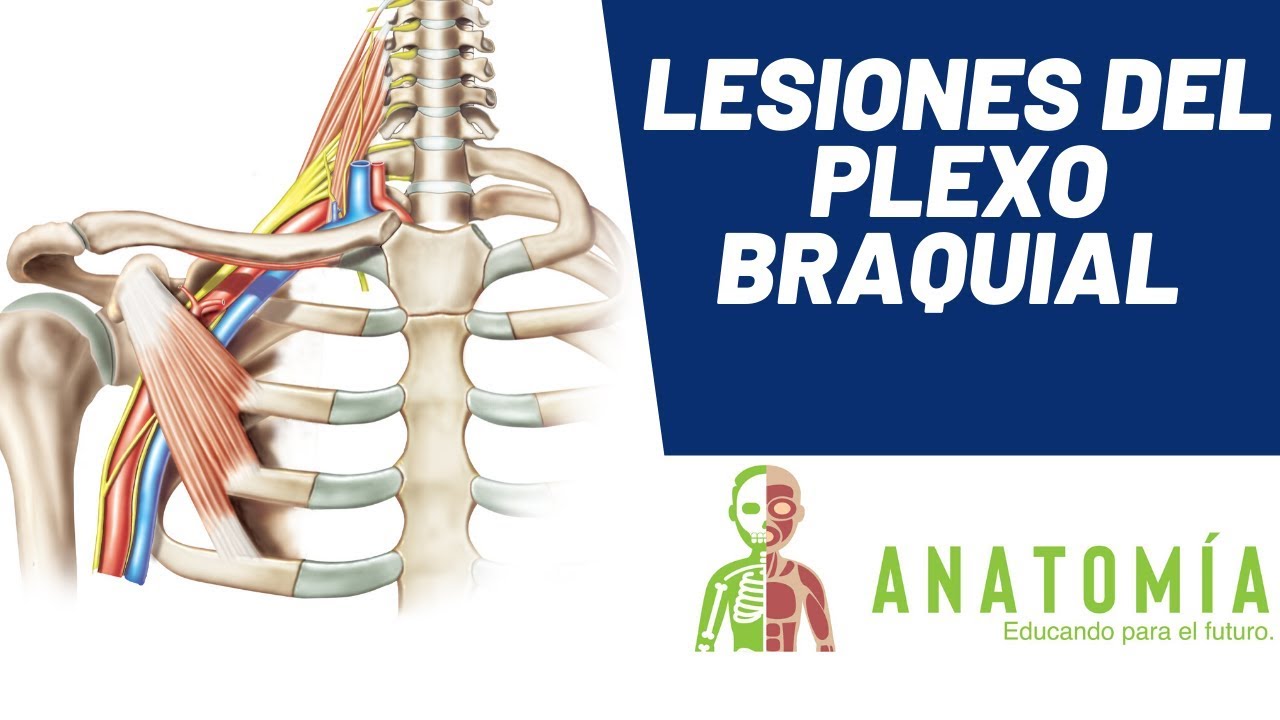 Lesiones más comunes del plexo braquial