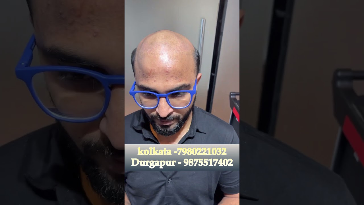 How to Do self Service of Hair Patch at Home| #hairpatch#hairreplacement #kolkata#hairwig#hair