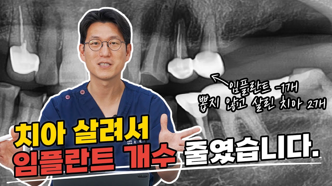 임플란트 하나 줄이고 치아 2개 살린 비결! 자연치아 살리는 치과의 치근단절제술 사례 분석