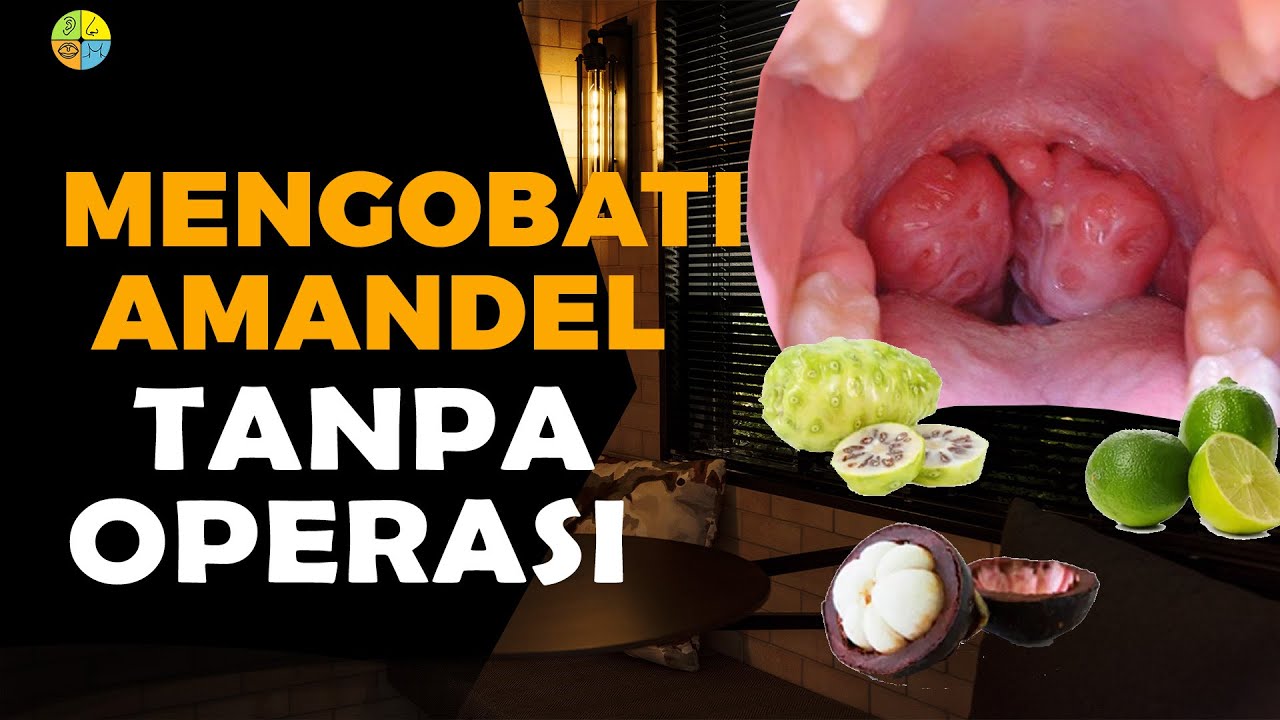 CARA MENGOBATI AMANDEL TANPA OPERASI