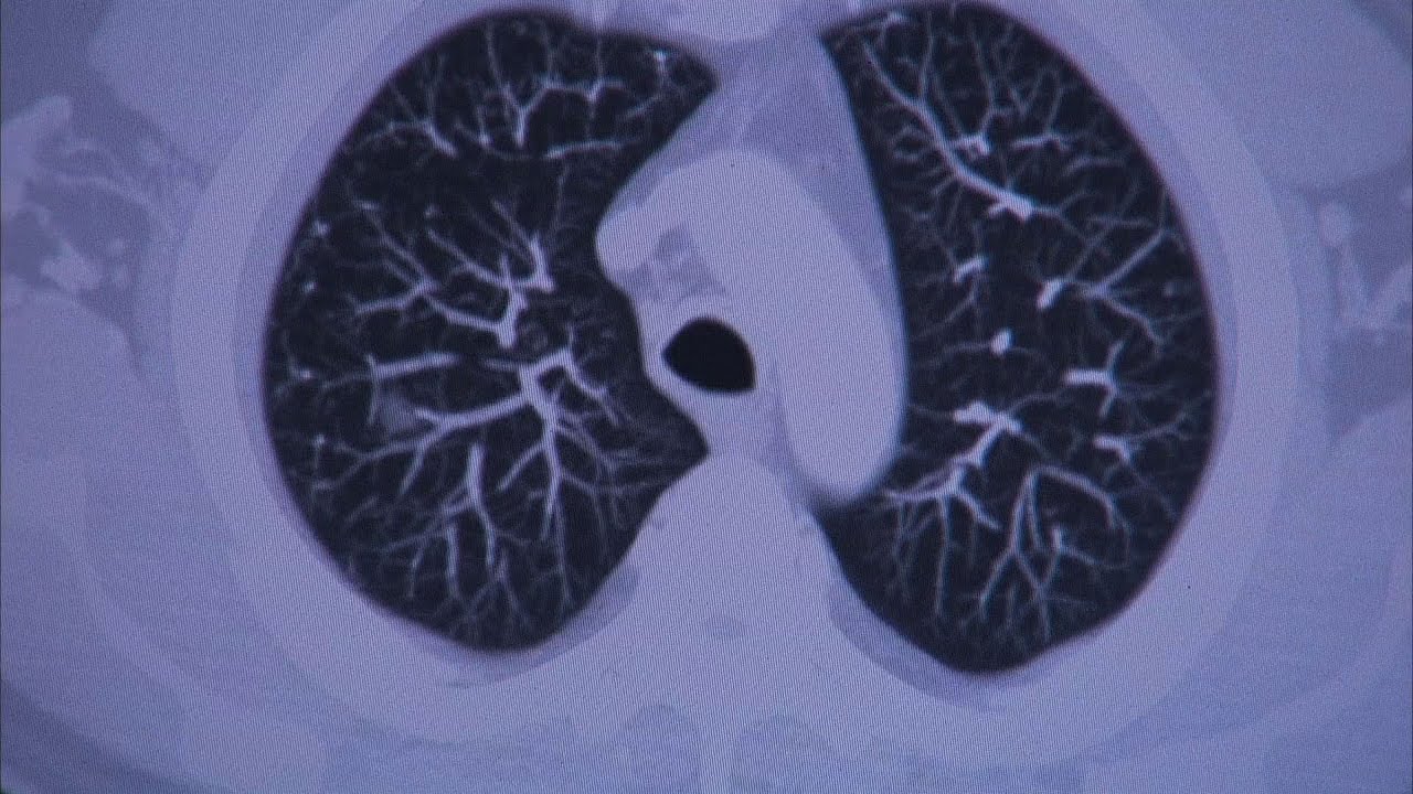 Lung Cancer Screening - Mayo Clinic